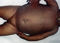 На снимке показан ребенок, страдающий нейробластомой. Разрастание опухолевых масс в брюшной полости является типичным признаком болезни