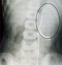 На этой контрастной рентгенограмме видна увеличенная почка (обведена) при опухоли Вильмса (нефробластоме)
